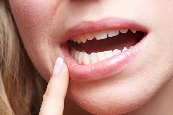 Răng lung lay là triệu chứng cảnh báo ung thư miệng.